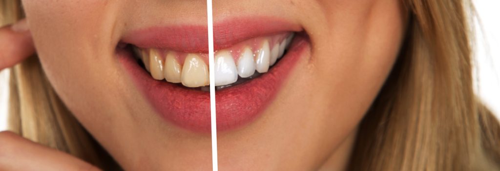 Wybielanie zębów — wszystko, co powinieneś wiedzieć